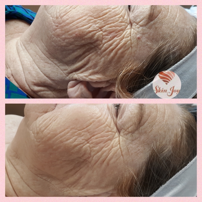 AMG Procell for sagging & wrinkling 2